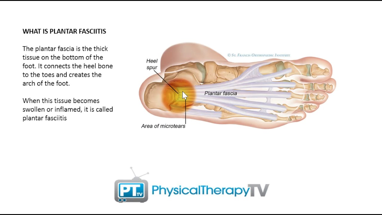 What is Plantar Fasciitis YouTube