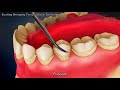 Teeth scaling to remove plaque - 3d animated video - Dental Solutions Clinic Bangalore