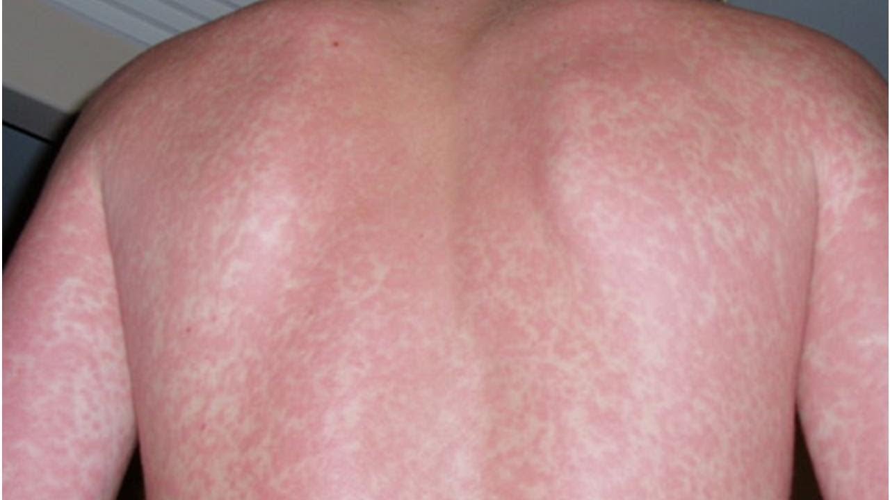 How To Tell The Difference Between Hives And Rashes Tita Tv Youtube