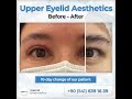 Upper eyelied blepharoplasty surgery  before  after  mezmd health tourism agency