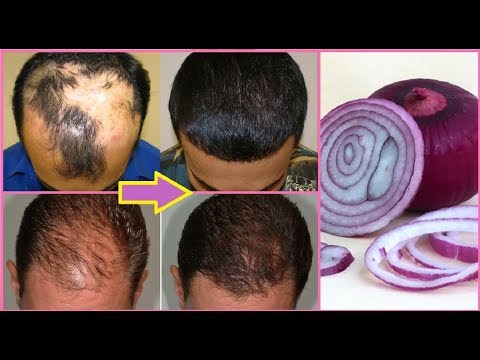 How to cure baldness in male – पुरुषों में गंजापन, गंजेपन से कैसे बचें | Hair Loss Remedy