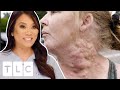 Woman’s Medication Makes Bumps Grow All Over Her Neck | Dr. Pimple Popper