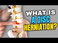 What Is a Disc Bulge?
