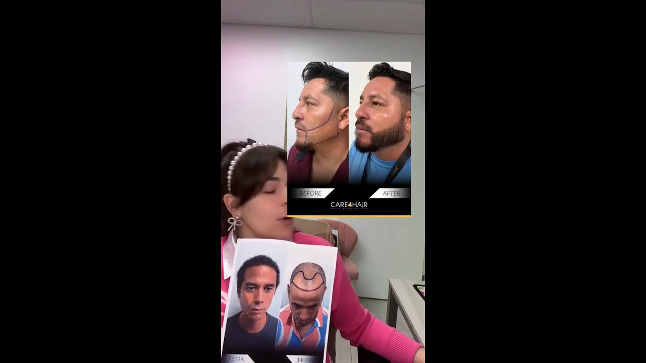 Transplante Capilar - Consulta Totalmente Gratis