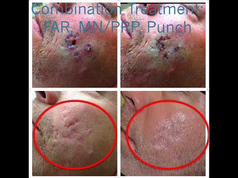 PUNCH EXCISION SURGICALLY REMOVES ACNE SCARS PERMANENTLY | West Hollywood, CA | Dr. Jason Emer