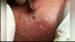 Blackheads Removal Full Video! Blackhead Extractions/ ЧИСТКА ЛИЦА Выдавливание Черных точек на лице