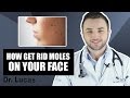 How get rid Moles on your face - Dr Lucas Fustinoni Brazil