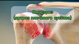 Омартроз (артроз плечевого сустава) #anatomy #doctor