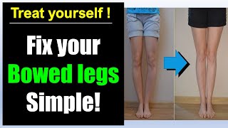 Bowed legs fix! Simple bowed legs exercise correction!