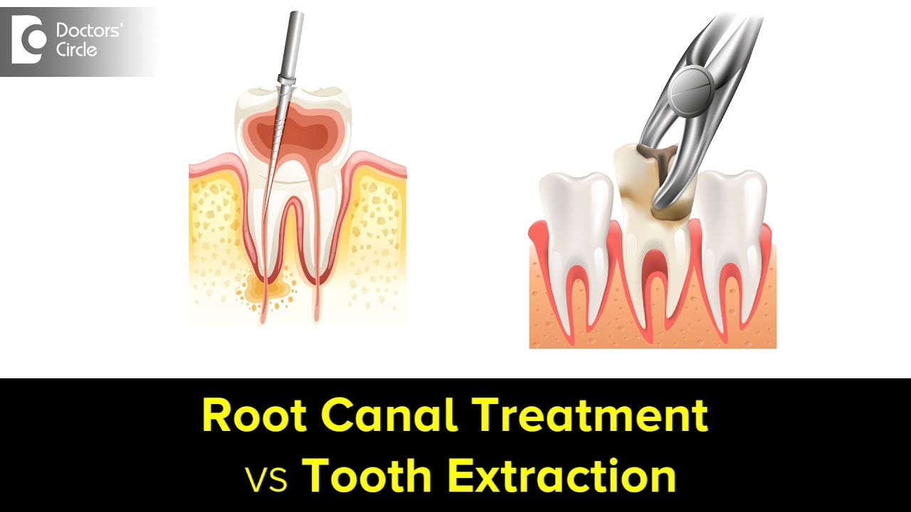 ⁣Root Canal Treatment vs Tooth Extraction. Which one is better?-Dr. Shahul Kamal Asif|Doctors' C