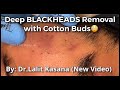 Deep blackheads removal with cotton buds by drlalit kasana
