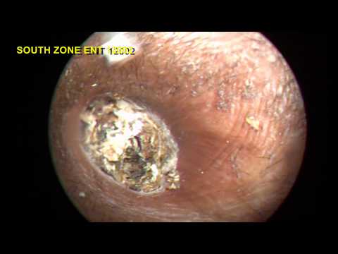 IMPACTED EAR WAX STONY HARD REMOVAL