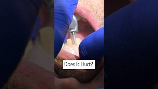 Famous "Do Dental Crowns Hurt? What to Expect During and After Your Crowns Procedure" #dentalcrowns Wealth