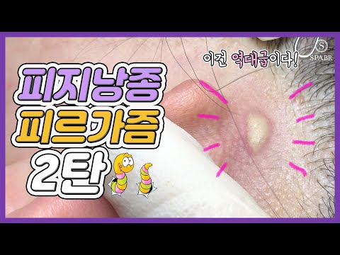 대왕 피지낭종 제거하기 - 깊은 곳의 피지까지 쏙! 여드름은 피르가즘은 스파비알 | Sebum Whitehead Extraction