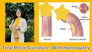 Peyronie’s Disease Homeopathic Medicine- Homeopathic Treatment For Penile Curvature- Dr Rukmani