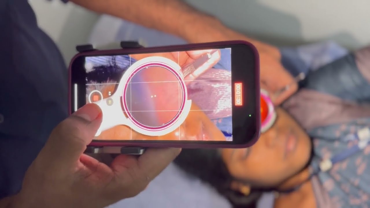 MII Ret Cam Based Peripheral Retinal Imaging with Live Indentation