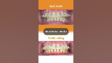 Hành trình LỘT XÁC nhờ niềng răng của Phụng Liên