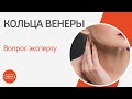 Кольца венеры: вопрос эксперту