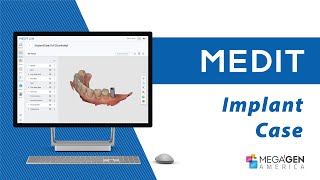 Implant Case Scan Using Medit i700W & Model