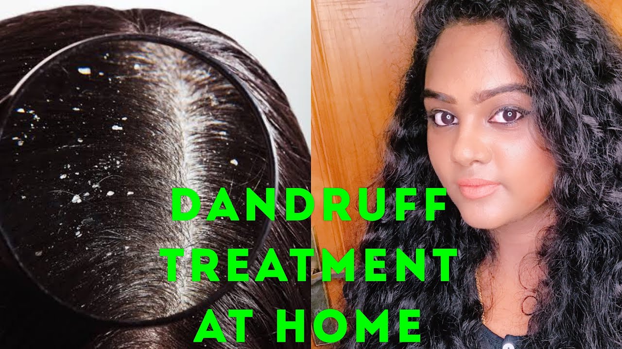 Home Remedies for dandruff Dandruff Treatment at Home Dusky Glam