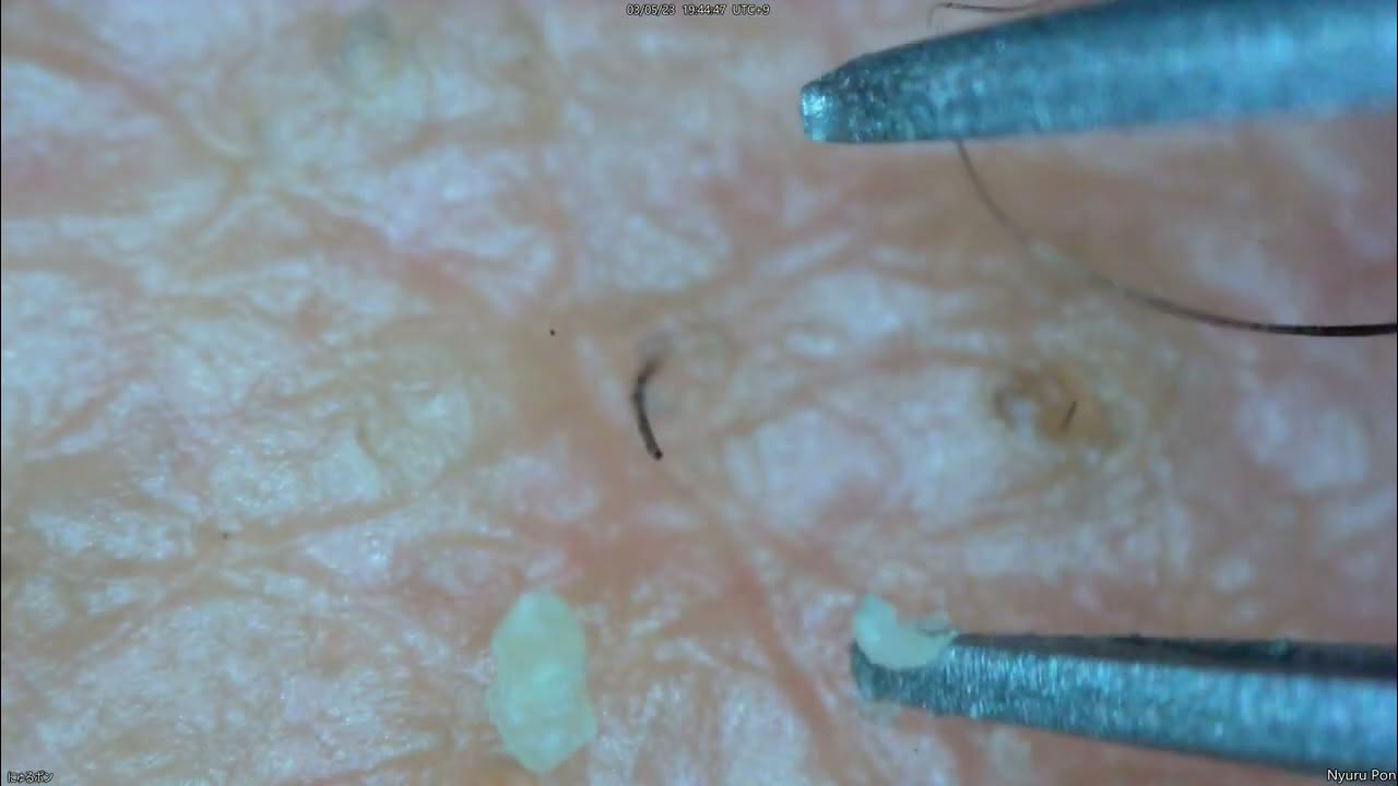 0164 keratin plug removal cheek YouTube