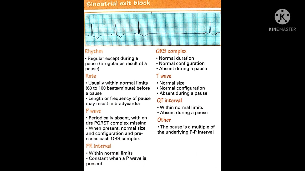 Sinoatrial exit block - YouTube