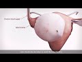 Laparoscopic ovarian cystectomy