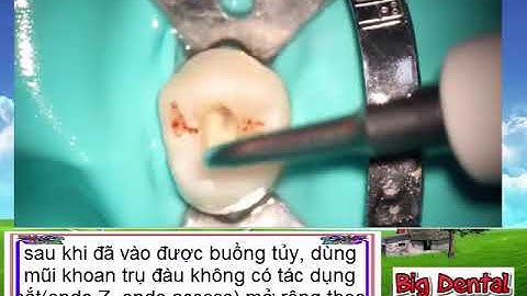 B.D: Mở tủy răng cối nhỏ hàm trên(Carlos Praco)