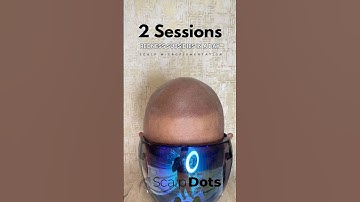 2 sessions of scalp micropigmentation and more session to go #scalpmicropigmentation #smp