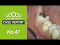 [MULTI_SUB] Monolithic zirconia crown preparation - [Dr. Na Kiwon]