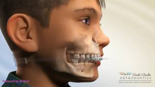 Class II Head gear - Cervical Pull - Orthodonitc Device