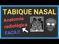 👃TABIQUE NASAL TAC (anatomía)