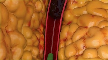 Peripheral Thrombectomy Animation