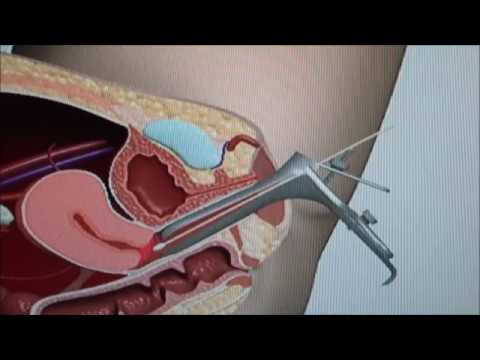 Video: Pap Smear (Pap-testi): Syyt, Menettely Ja Tulokset
