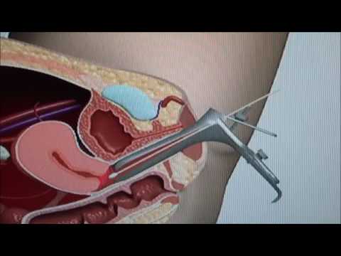 pap smear test