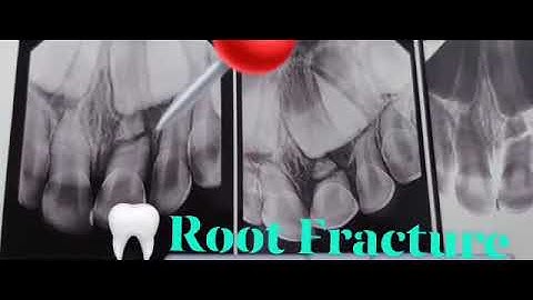 Traumatic Horizontal Root fracture of 1ry central incisor (periapical radiograph)splinting/exodontia