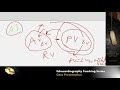 Case Study: Hemodynamics and multi valvular lesions