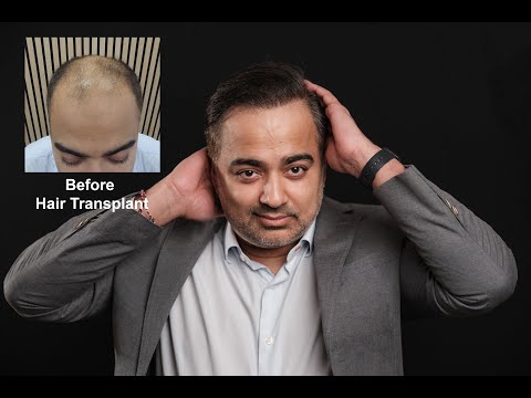 Harris Hair Transplant