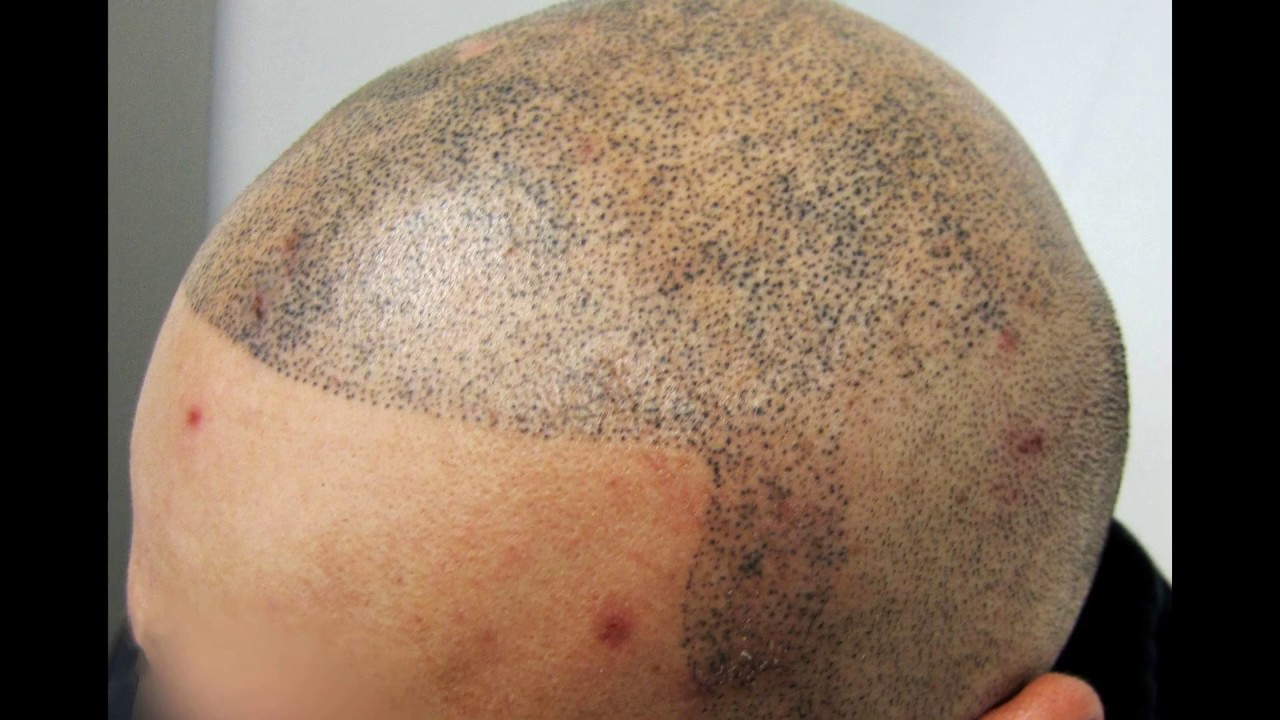 Hoe kun je lelijke MHP voorkomen? - Beauty Care Nederland