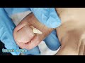 The best Method of Ingrown Toenail Removal Part5