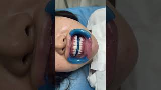 Tooth Filling ::: Cuspid Tooth Extraction ::: Teeth Expander Process ::: Teeth Cleaning  teeth