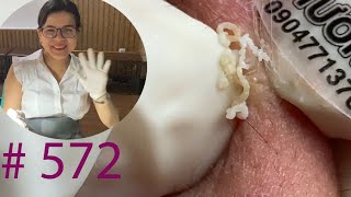 Acne Treatment Huong Da Nang#572 | 2023