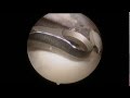 Arthroscopic Repair of a Retracted Subscapularis Tear