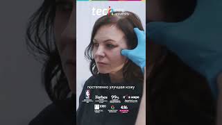 Рассасывающиеся имплантаты в эстетической медицине: безопасность, техники и биоматериалы