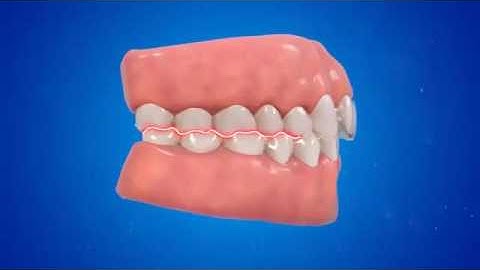 INVISALIGN - NIỀNG RĂNG TRONG SUỐT CHO KHỚP CẮN SÂU