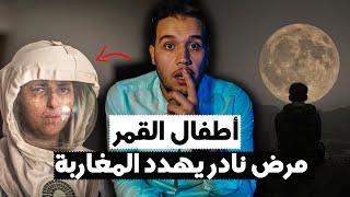 من هم أطفال القمر؟ | أغرب مرض قد تسمع به في حياتك