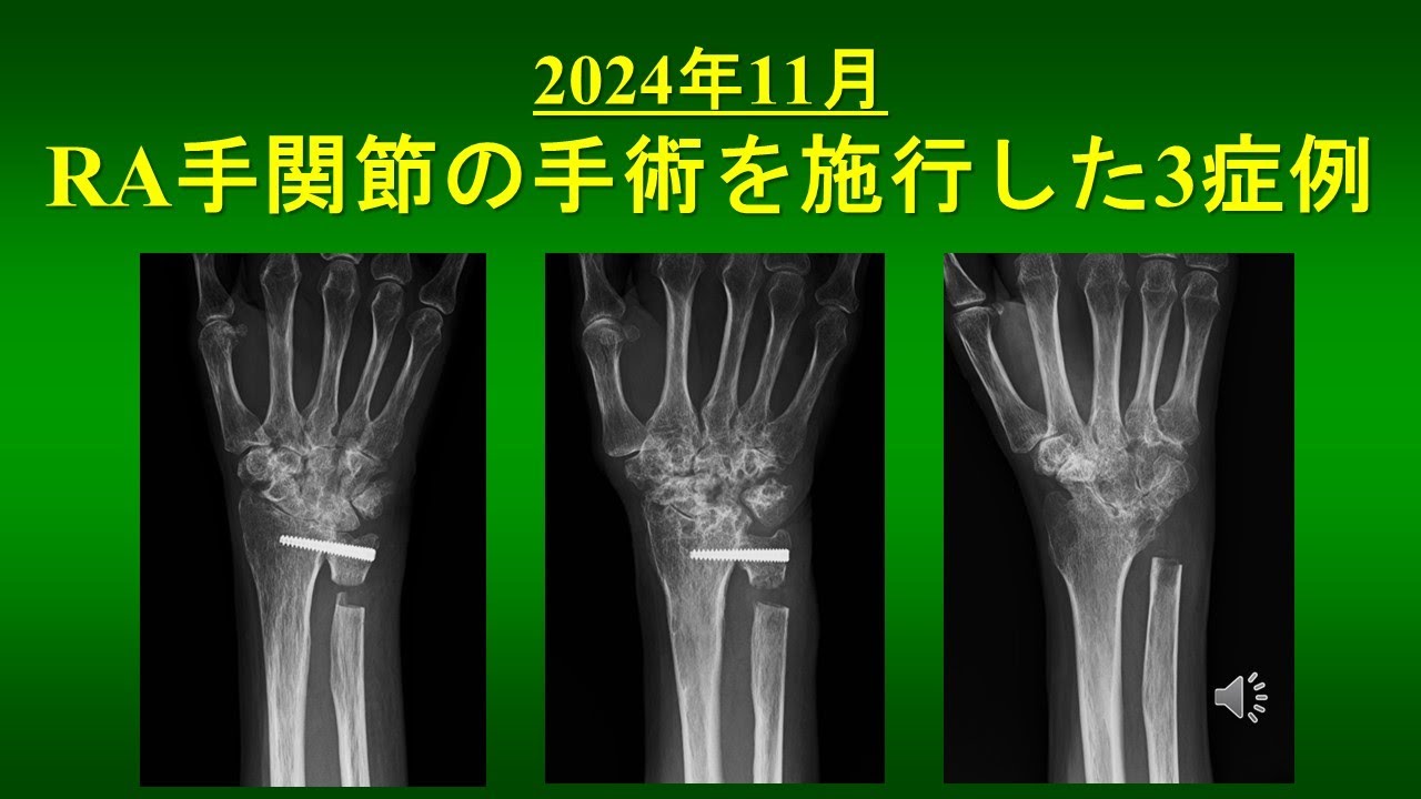 RA手関節の手術を施行した 3症例 （2024年11月施行） - YouTube