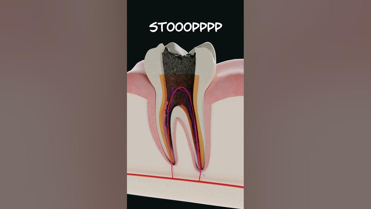 The brutal reality of tooth decay The brutal reality of tooth decay