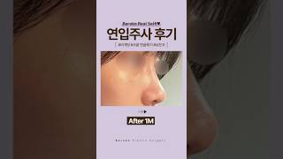연입주사 후기💜 #비개방코성형 #연입코 #연입주사 #무보형물