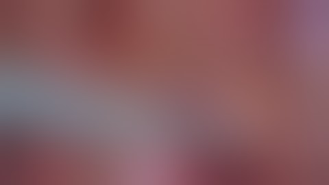 Laparoscopic Uretero-calicostomy by Dr Shashikant Mishra